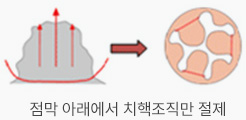 점막 아래에서 치핵조직만 절제